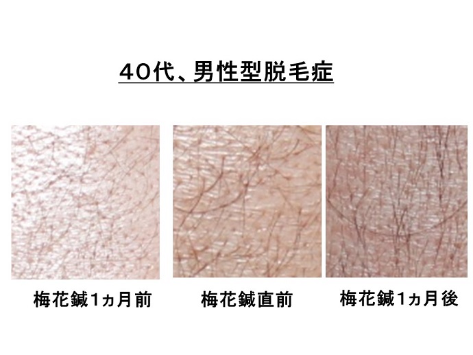円形脱毛症　病院